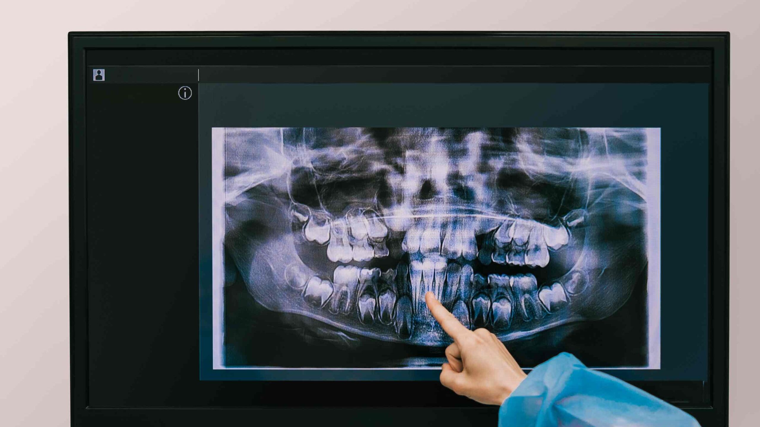 Dentist pointing at a panoramic dental X-ray on a screen, illustrating how tooth count and case complexity affect Hollywood smile pricing.