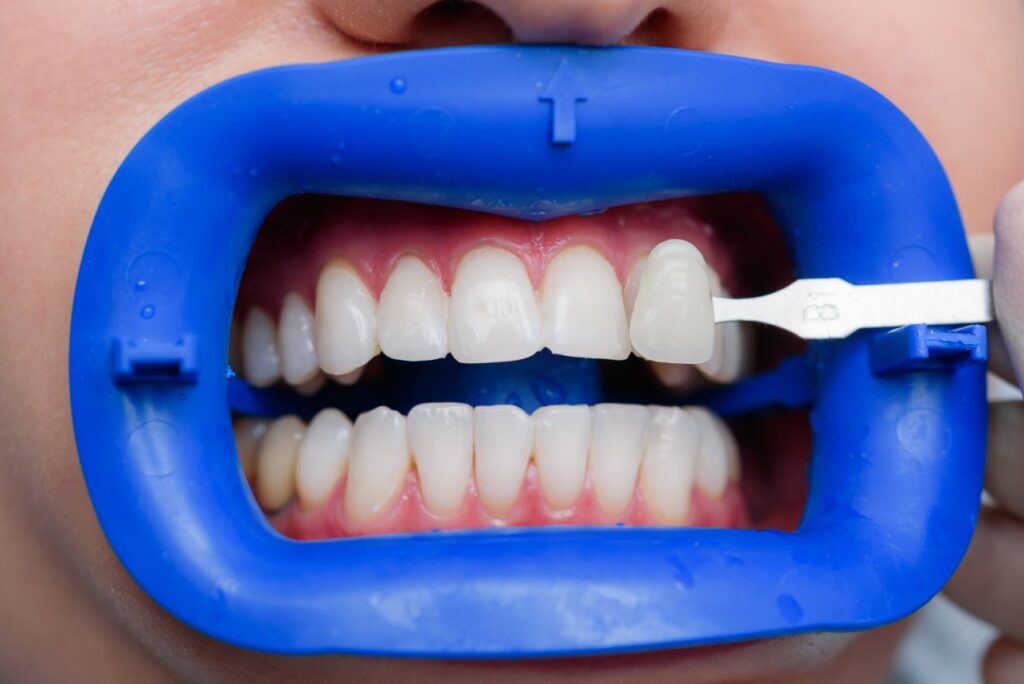 Teeth shade matching during whitening planning using a dental shade guide with cheek retractor in place