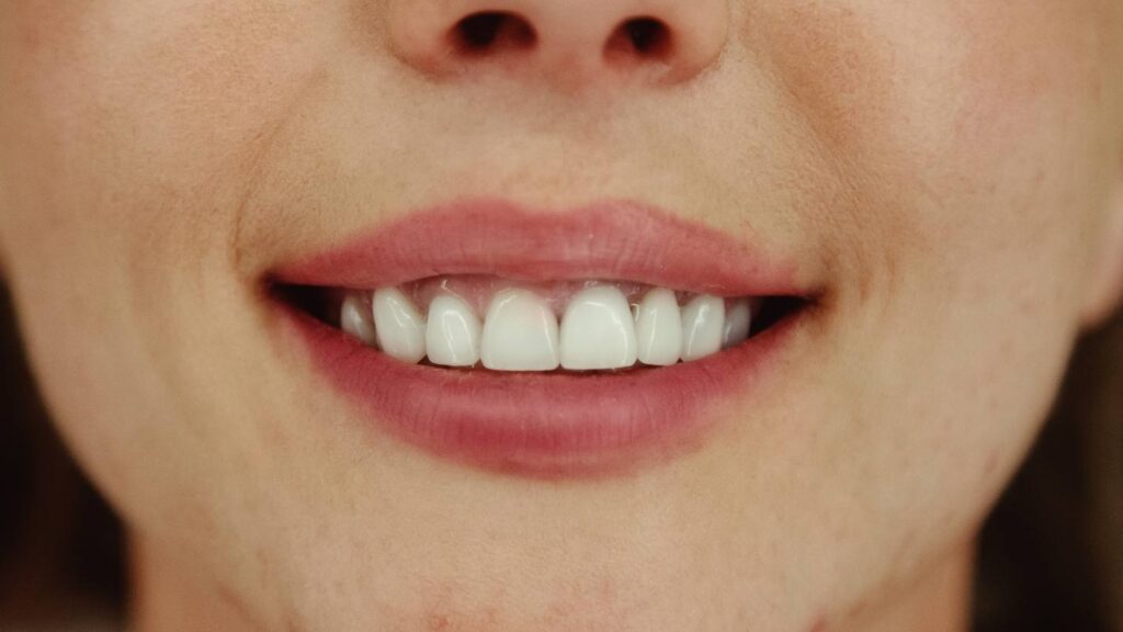Close-up smile showing visible upper teeth to help decide between 6 vs 8 vs 10 veneers