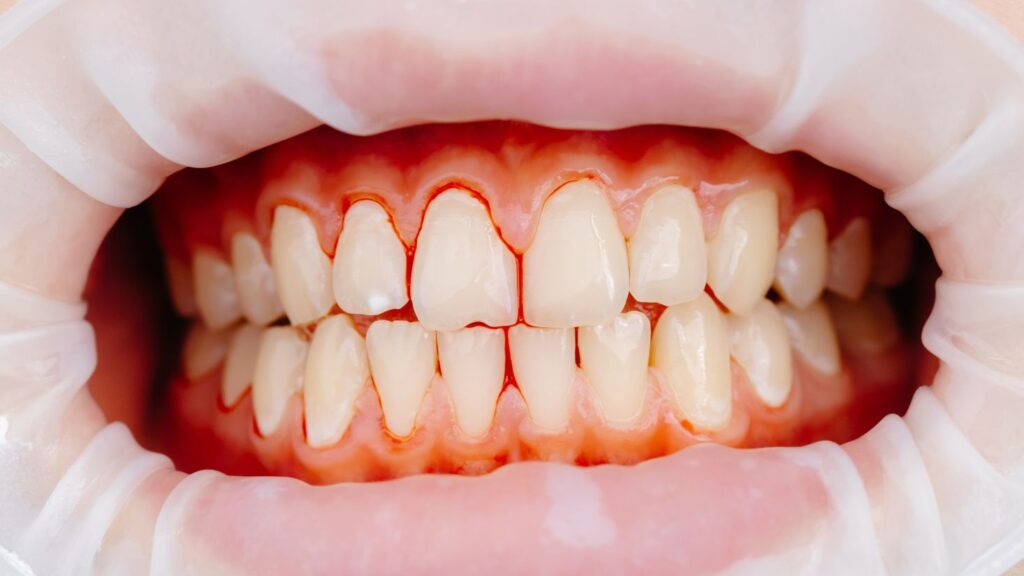 Teeth and gums with red outline highlighting common reasons veneers fail early