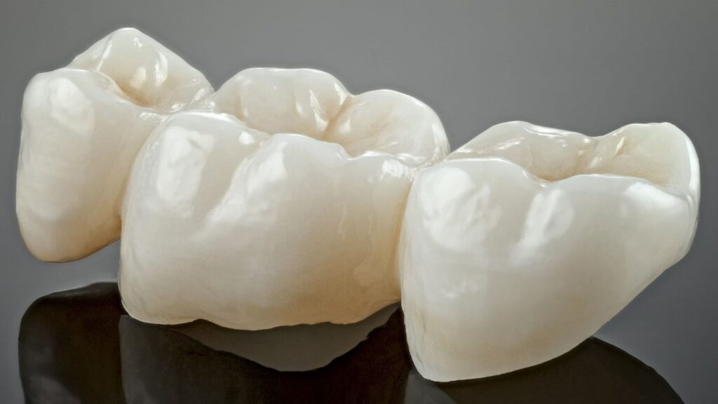 Close-up of a porcelain dental crown restoration showing full-coverage crown shape