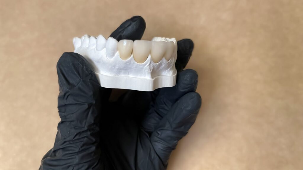 Gloved hands holding a dental model with several tooth crowns on the upper front teeth.