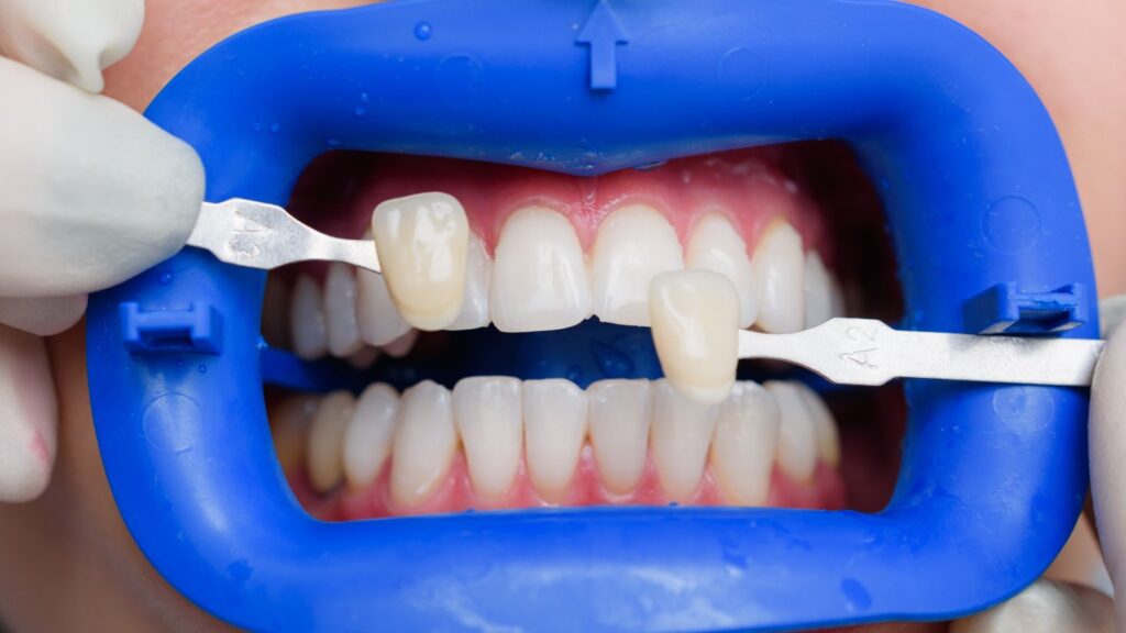 Dentist compares veneer shade tabs to a patient’s teeth using a blue cheek retractor.