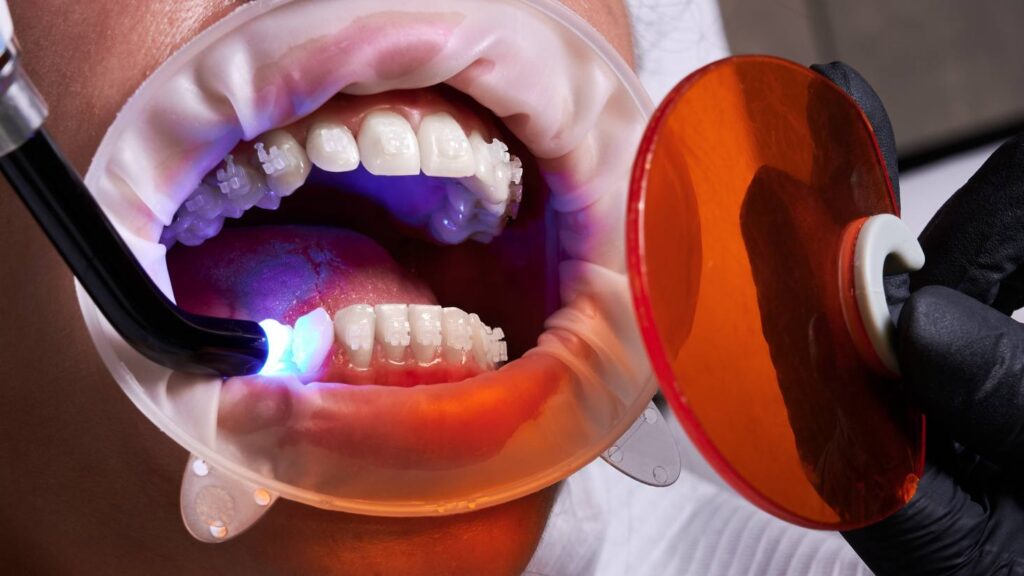 Dentist applying composite dental bonding with a curing light on front teeth