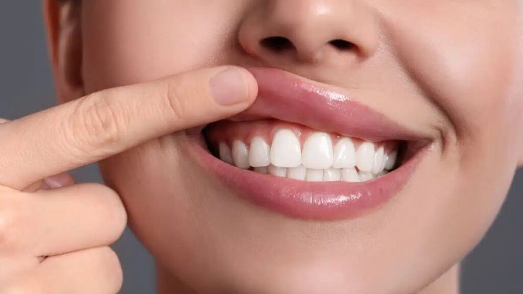 gum contouring before veneer
