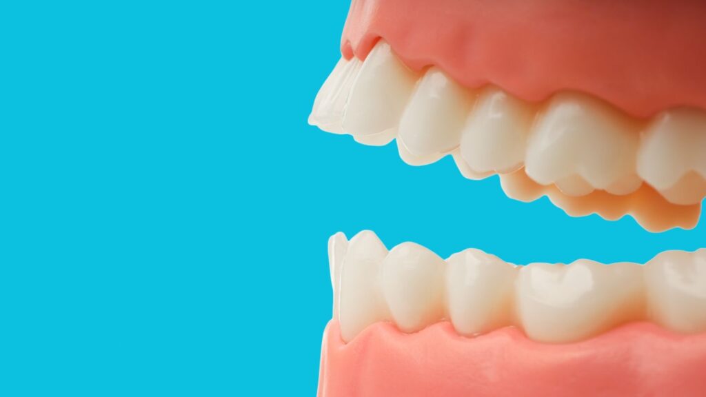 Dental model showing upper and lower teeth, representing why bite alignment should be checked before veneers or crowns.